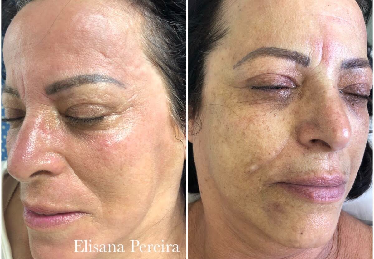 Cuidados para melasma