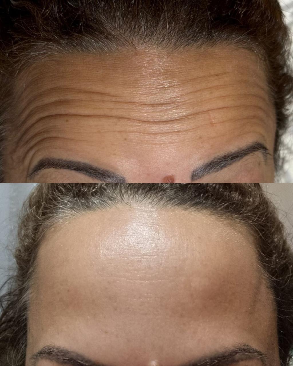 Aplicação de Botox / toxina botulínica